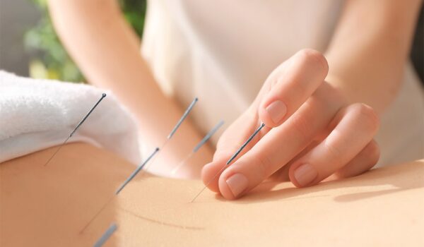 beneficios-de-la-acupuntura